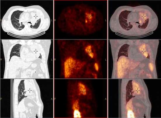 Carcinoid a bal tüdőben?