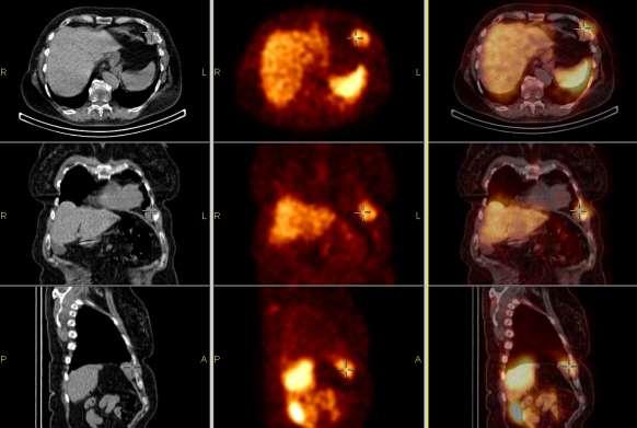 Carcinoid pleurával