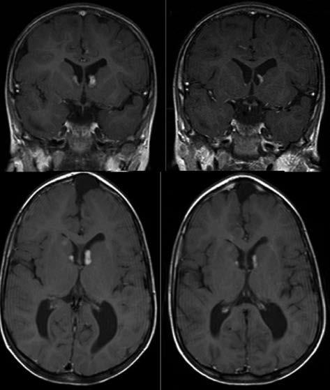 regular abdominal MRI would be the ideal tool for screening and follow-up of kidney AMLs.