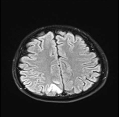 A B Figure 1A, B. A cortico-subcortical focal area with hyperintense signal changes in T2-FLAIR and diffusion-weighted MR imaging, in right parietooccipital region noticed 4.