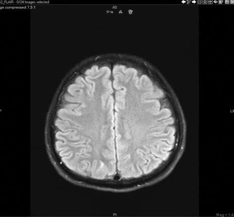 A B Figure 2A, B. One month later, T2-FLAIR and diffusion-weighted sequence with an unknown incidence 8.