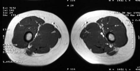 A juvenilis dermatomyositis diagnosztikájában a képalkotó vizsgálatok közül az MR-vizsgálaton kívül a jövõben az MR-spektroszkópiának és a