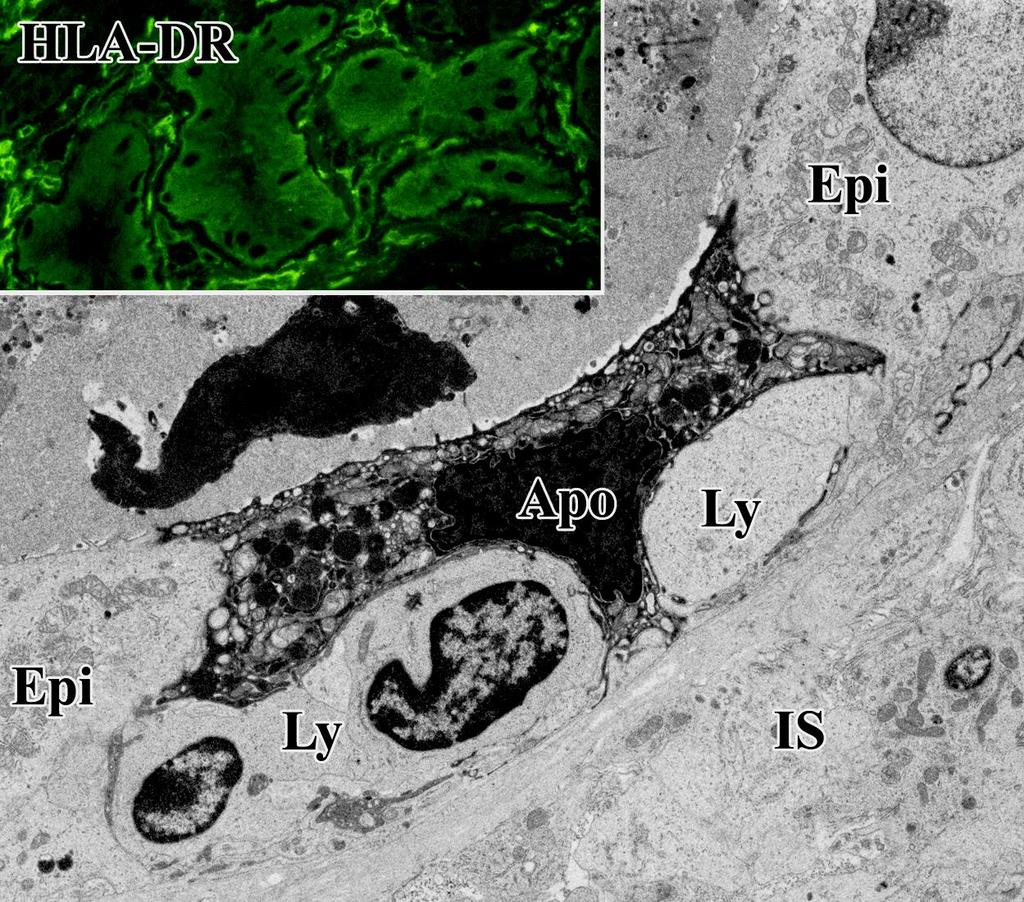 Beültetett vese kilökődése Apoptosis: a cytotoxikus T-lymphocyták (ly) a