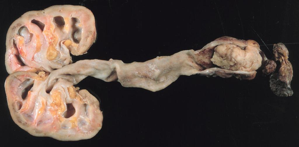 Hydronephrosis: a húgyvezeték