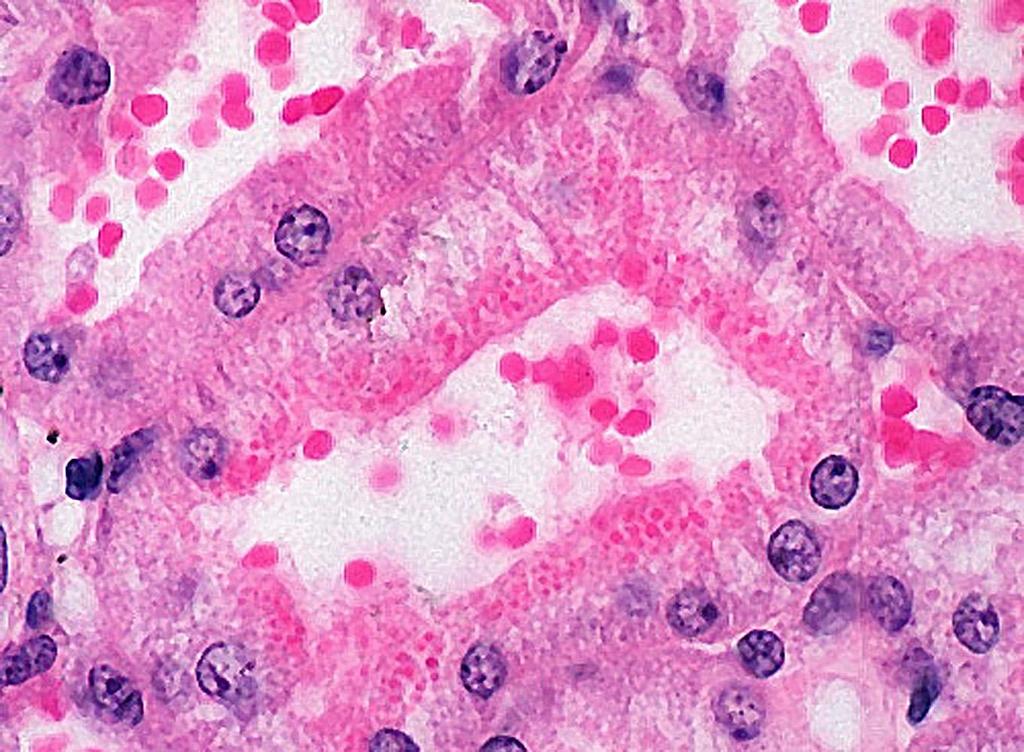 Hyalincseppek a