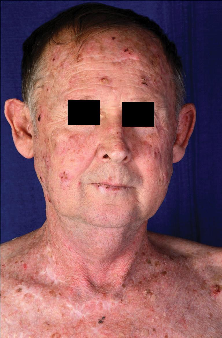 1. ábra Számos aktinikus keratosis, NMSC és a korábbi műtétek hegei 3. ábra 6 hónappal az everolimusra való átállítást és cryotherapiákat követően 2.
