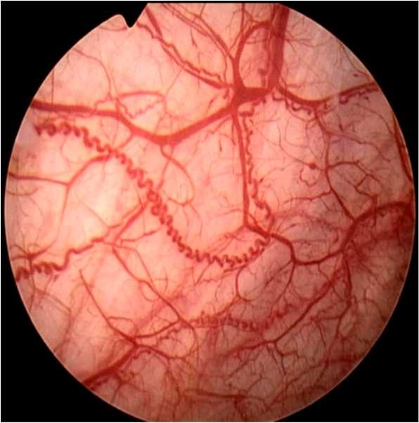 A diagnosztika legfontosabb eszközének korábban a Parsons féle kálium terheléses tesztet tartották, ami 0,4 mol-os kálium klorid oldat beadására kapott fájdalmas reakcióval igazolta a GAG réteg