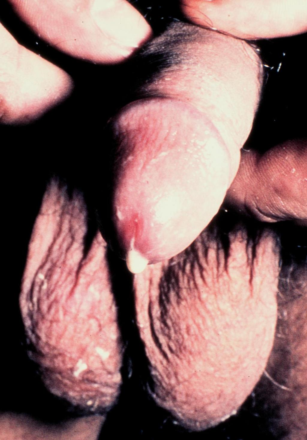 Gonorrhoea (kankó) 2-7 nappal a fertőződést követően heveny gennyes urethritis: gyakran gennyes vesiculitis, prostatitis, epididymitis is fennáll Késői