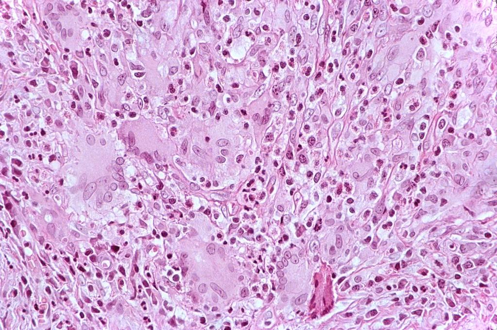 Destruált acinusokat epitheloidsejtek és egyéb