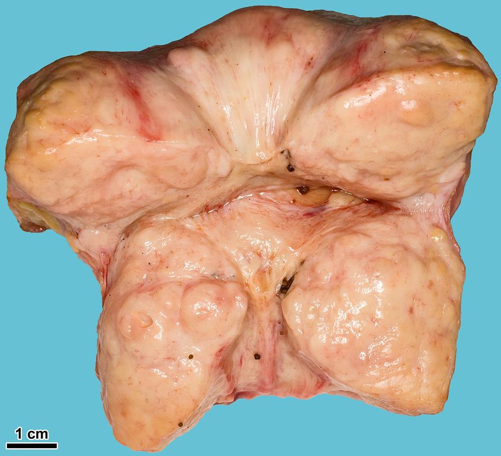 Makro: göbös, nagyobb prostata (60-100 g;
