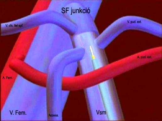 Lézer-szál végének helyzete A SF junkció alatt 0 0,5 1,0-2,0