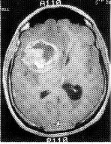 Etiopatológia Központi idegrendszeren belül Neurodegeneráció