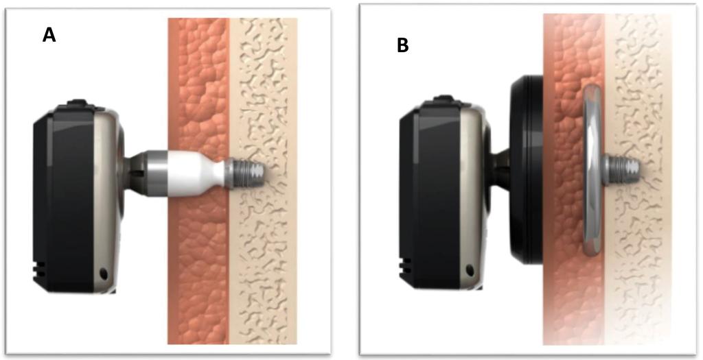 1. ábra Baha Connect (A) és Attract (B) rendszerek (Copyright 2016 Cochlear Ltd. Minden jog fenntartva. Engedéllyel átvéve) sének fracturájához vezethet, amely az implantátum elvesztését okozhatja.