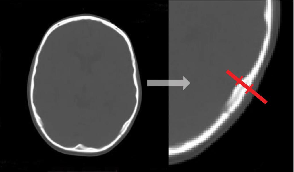 elkerülhetővé válik [16]. A műtéteket 5 mm-es implantátummal végeztük. A betegek követési ideje minimum hat hónap volt. A beszédprocesszorokat a posztoperatív negyedik héten illesztettük.