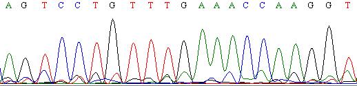 A molekuláris genetikai diagnózis eredménye Exon 5 Ser Pro Val STOP Asn Gln Gly c.748 C/T p.