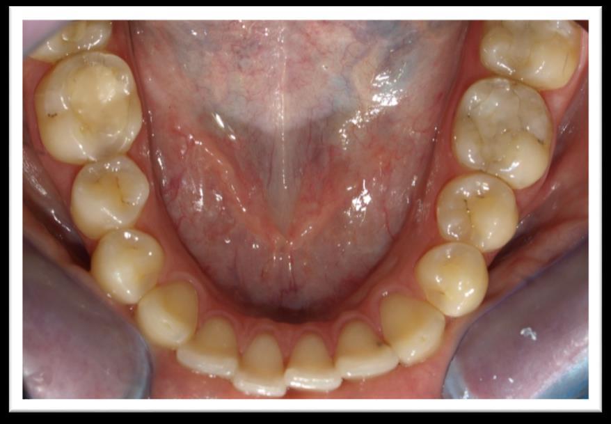 ALSÓ ÁLLCSONT DENTALIS STÁTUS KONZERVÁLÓ FOGÁSZATI STÁTUS (mandibula) Foghiány Caries Tömés Gyökértömés Betét nincs 32D, 46M 37O, 36O, 46MO, 47O (kompozit)