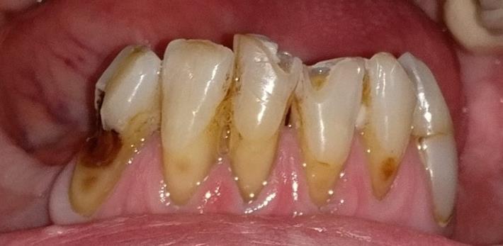 Status - Alsó álcsont Alsó fogív: 3 2 1 1 2 3 43 buccalisan caries media vitalitásvizsgálat: normális hidegérzékenység 33 nyaki tömés