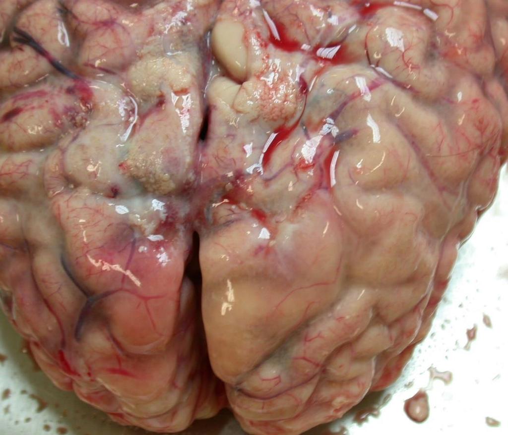 Meningitis- Makroszkóposan Általában az agyféltekék konvexitása érintett Lágyagyhártya