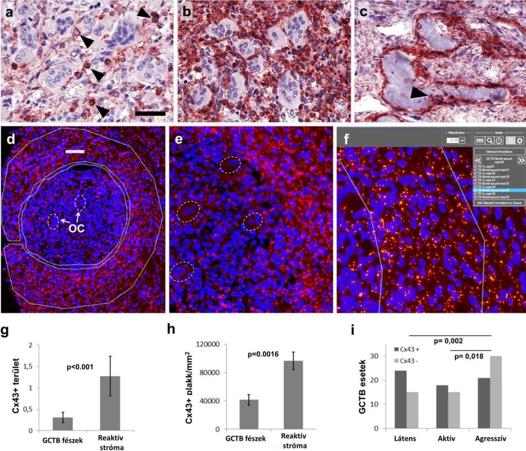 86. 32. ábra. A Cx43 fehérje szintjének meghatározása immunperoxidáz (a-c) és immunofluoreszcens (de) módszerrel óriássejtes csontumorok osteoclast-gazdag régióiban.