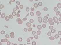 Klinikai gyanú: hányás, hasmenés, anaemia, thrombocytopaenia, veseelégtelenség, neurológiai tünetek Klinikai diagnózis: Thrombotycus microangiopathia (TMA) Haemolyticus anaemia