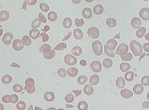 Klinikai gyanú: hányás, hasmenés, anaemia, thrombocytopaenia, veseelégtelenség, neurológiai tünetek Klinikai diagnózis: Thrombotycus microangiopathia (TMA) Haemolyticus anaemia