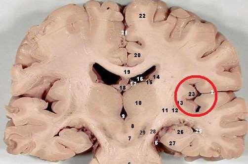 A telencephalon lebenyei insula a sulcus lateralis mélyén a frontalis és a temporalis