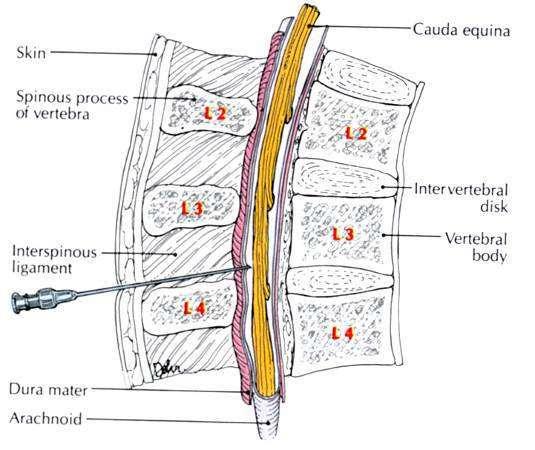 Lumbalis cisterna, lumbalpunctio bőr lig. supraspinale lig interspinale lig.