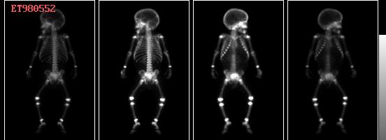Normális csontszcintigram fiataloknál 17 18