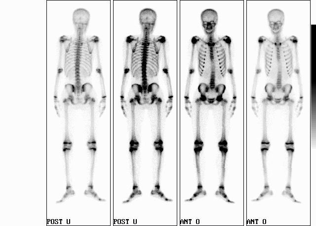 fázisú csontszcintigráfia szerepe A vérátfolyás