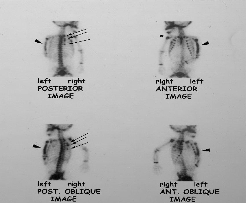 differeneciáldiagnosztikája Osteosarcoma nem a