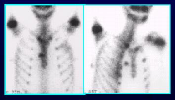 Acute pyelonephritis ábrázolása C.