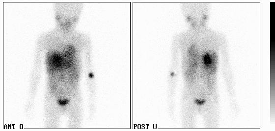 I 123/I 131 MIBG: Indikációk A. Igazolni gyanús neuroectodermalis eredető tumorokat beleértve a neuroblastoma, phaeochromocytoma and ganglioneuroma. B. Stádium meghatározása ezeknek a betegségeknek C.