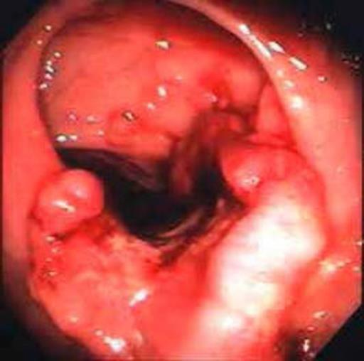 Colonoscopia A colon ascendensben 3 cm hosszú, a falat körkörösen infiltráló, a lument szinte teljesen beszűkítő, kifekélyesedett,