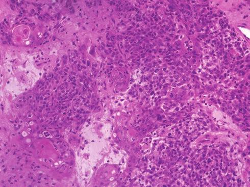 A nem HPV-asszociált bazaloid laphámkarcinómák agresszív, rossz prognózisú daganatok (6).