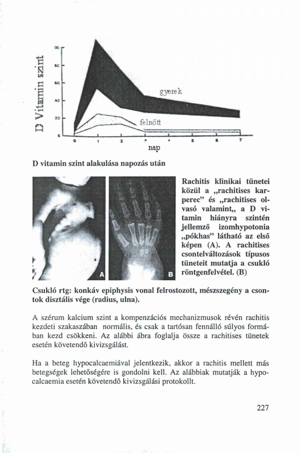 nap D vitamin szint alakulása napozás után Rachitis klinikai tünetei közül a rachitises karperec" és rachitises olvasó valamint,, a D vitamin hiányra szintén jellemző izomhypotonia pókhas" látható az