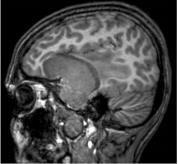 [9] A T1 súlyozott felvételen hypointenzek, míg a T2 súlyozott felvételen általánosságban enyhén hyperintenz képet adnak.