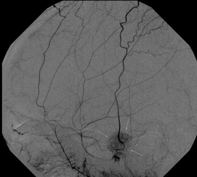 -én a bal oldali temporo-basalis 2 cm-es elváltozás egyedül a bal carotis externa felől telődik, meningeomára utaló késői kimosódással, így a DSA laborban preoperative embolizálták.