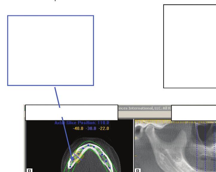 Implantáció tervező nézet (kattintson kétszer a panoráma nézetre a főmenü ablakban). A következő képet kell látnia: A kék pontokra kattintva és azokat mozgatva beállíthatja a panoráma nézet síkját.
