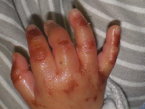 napján véres székletürítés, epés reziduum, emelkedett gyulladásos paraméterek jelentkeztek, az elvégzett hasi UH vizsgálat necrotizáló enterocolitis maradványtüneteit írta le, emiatt teljes