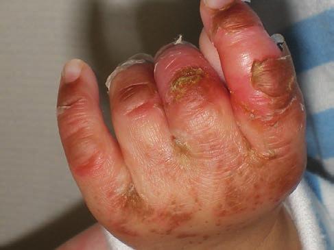 2.b, c ábra A kézujjakon, a kézfejeken, a lábujjakon és a lábfejeken hólyagképződés, erosio, lemezes hámlás figyelhető meg szubsztitúciós kezelés beállítását