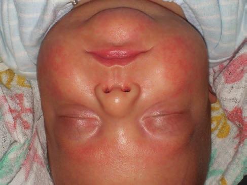 A betegnél genomi DNS-ből végeztük el az acrodermatitis enteropathica hátterében álló gén, az SLC39A4 kódóló szakaszainak és az azokkal határos intronális szakaszok