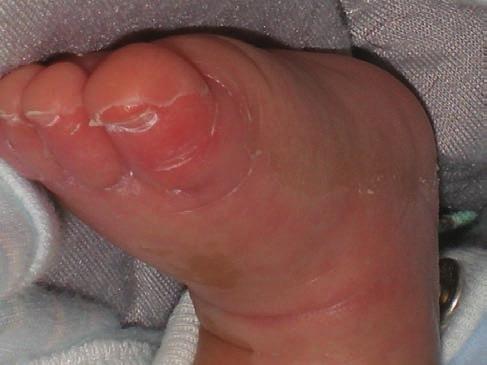 a, b, c ábra A cink pótlást követően teljes gyógyulás észlelhető Az acodermatitis enteropathica diagnózist Danbolt és Closs vezette be 1942-ben (1), azonban közel 30