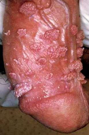 org) HPV 6 and 11 responsible for >90% of anogenital warts 1 Clinically