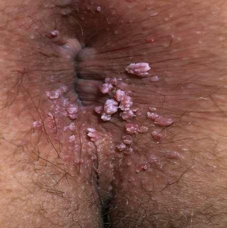 lifetime risk of developing genital warts ~10% 3,4 1. Jansen KU, Shaw AR.