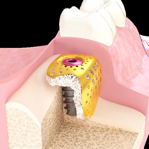 BIONIKA BIONIKA MEDLINE KFT info@bionika.hu www.bionika.hu www.implantshop.