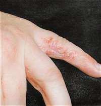 7.rész Harc a gombásodás, a psoriasis, az ekcéma ellen Sófürdő a különböző testrészekre Sajnos ma már szinte népbetegség a gombásodás, mely élete során szinte mindenkit érint több-kevesebb alkalommal.