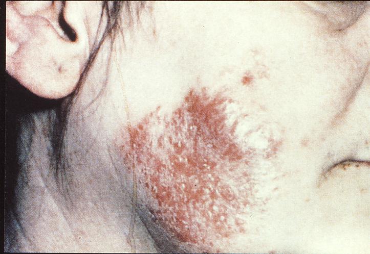 Bőrfarkas/Lupus vulgaris.