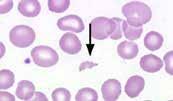 Haematológia (IDEXX ProCyte DX): RBC: 4,55 T/l (5,7-8,8); WBC: 6,3 G/l (5,2-13,9) nrbc+: 10/100 wbc (0-2) B: 102 g/l (129-184) HT: 33 % (37-57) MCV: 74 fl (60-72) MCH: 19,2 g/l (20,5-24,2) MCHC: 298