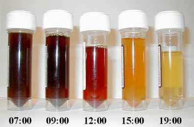 Haemolitikus anemia laboratóriumi jellemzői Indirekt szérum bilirubin emelkedés Fokozott UBG ürítés Magas LDH szint Csökkent haptoglobin szint