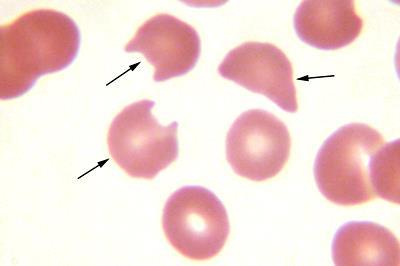 Szerzett haemoliticus anaemia Nem immun eredetű, un. vvt. fragmentációs sy.